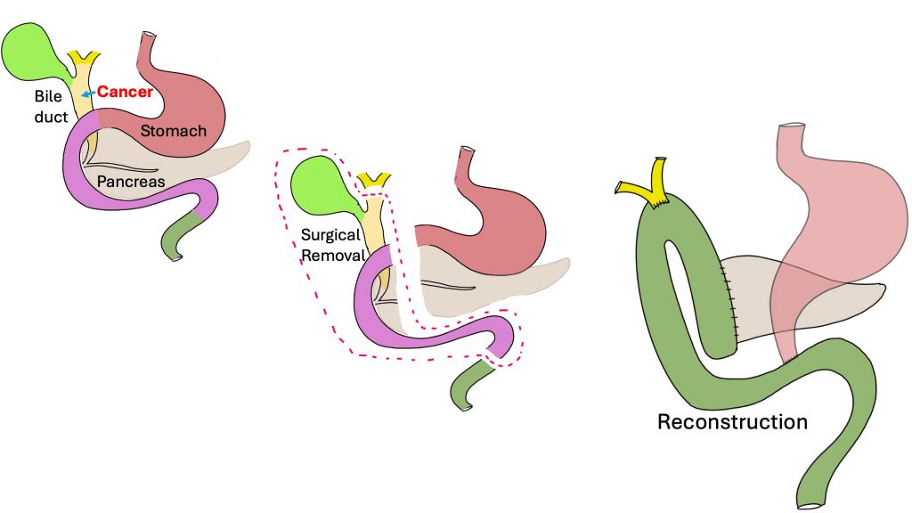 Robotic Pylorus – Preserving Whipple Procedure